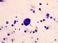 Pyuria & hematuria (Wright