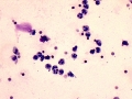 Pyuria & hematuria (Wright