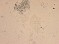 Urothelial carcinoma