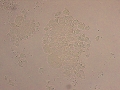 Urothelial carcinoma