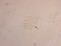 Urothelial carcinoma