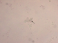 Urothelial carcinoma