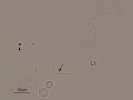 Lymphoma
