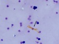 Bilirubin & WBC (Wright's)