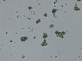 Ammonium biurate & calcium oxalate