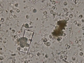 Ammonium biurate & struvite