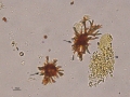 Bilirubin & granular cast