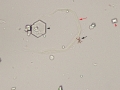 Bilirubin & calcium oxalate & cystine