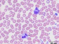 "Gray" eosinophil