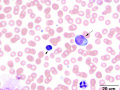 Lymphoma (B cell, dog)