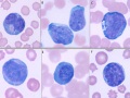 Reactive lymphocytes & leukemia