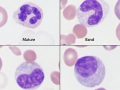 Immature neutrophil compilation
