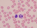 Phagocytized debris in neutrophil