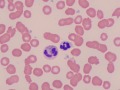 Phagocytized debris in neutrophil