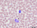 Reactive lymphocyte
