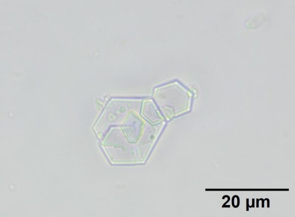 Urine sediment, unstained, 100x objective.