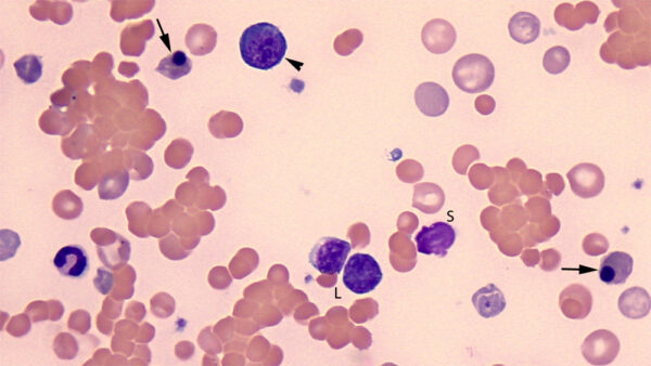 nRBC vs lymph