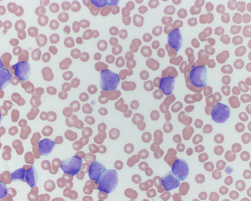 Acute myeloid leukemia in a dog (venous blood) | eClinpath