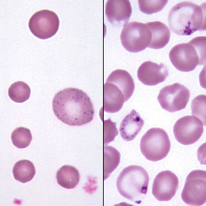 pappenheimer bodies vs basophilic stippling