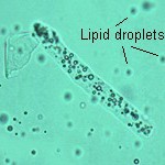 Fatty cast containing lipid droplets.
