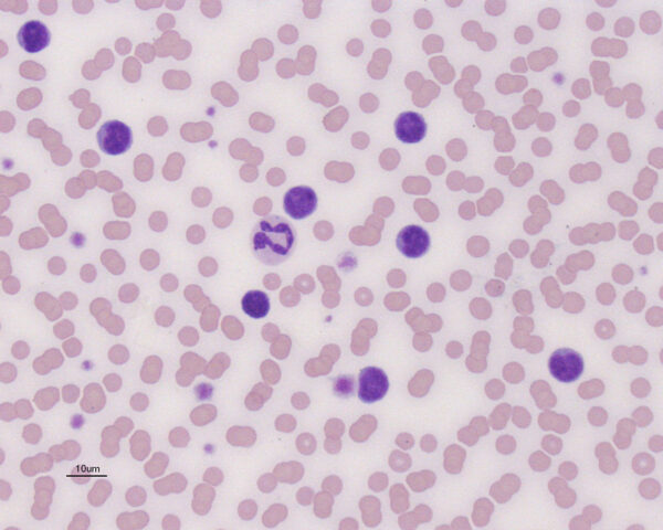 CLL