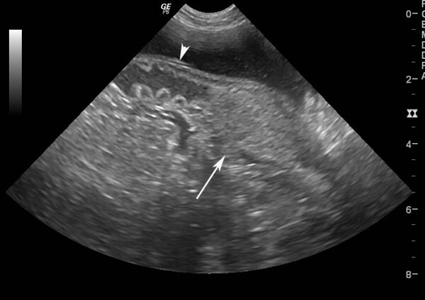 Ultrasound of challenge #5