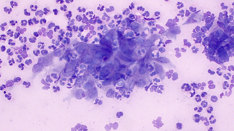 Cytologic Atypia (cornea) 