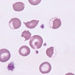 Eccentrocytes on a blood smear from a dog with onion toxicosis.