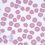 Echinocytes in freshly-collected blood from a horse with colic.