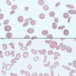 Blood smears from a cat with hepatic lipidosis