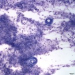 Figure 1. Tracheal wash sediment smear (Wright's stain, 10x)