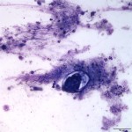 Figure 4. Tracheal wash sediment smear (Wright's stain, 20x)