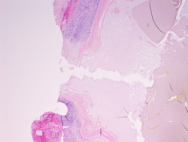 Mucocele H&E