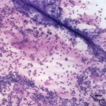 Figure 1: Tracheal wash direct smear (Wright's stain 100x)