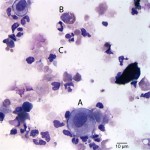 Figure 1: Cytospin smear from urine sediment  (Wright's stain)