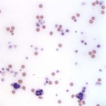 Figure 1: Peripheral blood smear (Wright's stain, 500X)