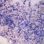 Figure 1: Right adrenal gland mass touch impression smear. (Wright’s stain, 200x)