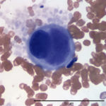 Figure 2. Large cell in the peripheral blood. (Wright's stain, 100x)