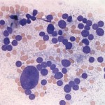 Figure 2: Right adrenal gland mass touch impression smear. (Wright’s stain, 500x)