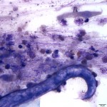 Figure  2. Tracheal wash sediment smear (Wright's stain, 50x)