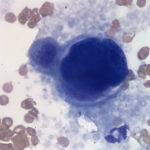 Figure 3. Large cell on a peripheral blood smear. (Wright's stain, 100x)