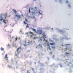 Figure 4:  Cytologic appearance of intact follicular cyst (Wright's stain, 10x)