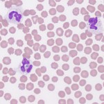 Figure 1: Blood smear (500x, Wright's stain)