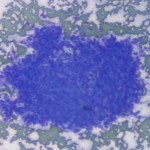 Figure 1: Aggregate of cells in blood (Diff-quik®, 100x)