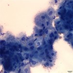 Figure 1: Impression smear. Wright’s stain, 500x magnification