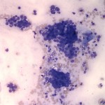 Figure 1: 200x magnification of an impression smear from a nasal mass of the a cat (Wright's stain)