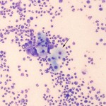 Figure 1: Low power peritoneal fluid smear (100x, Wright's stain)