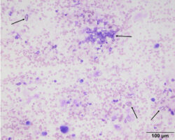 Figure 1: Direct smear of an aspirate from a mass near the right ...