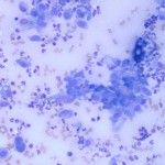 Figure 1: FNA of digital swelling (20x, Wright's stain)