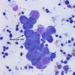 Figure 1a: Neoplastic cells (500x, Wright's stain)